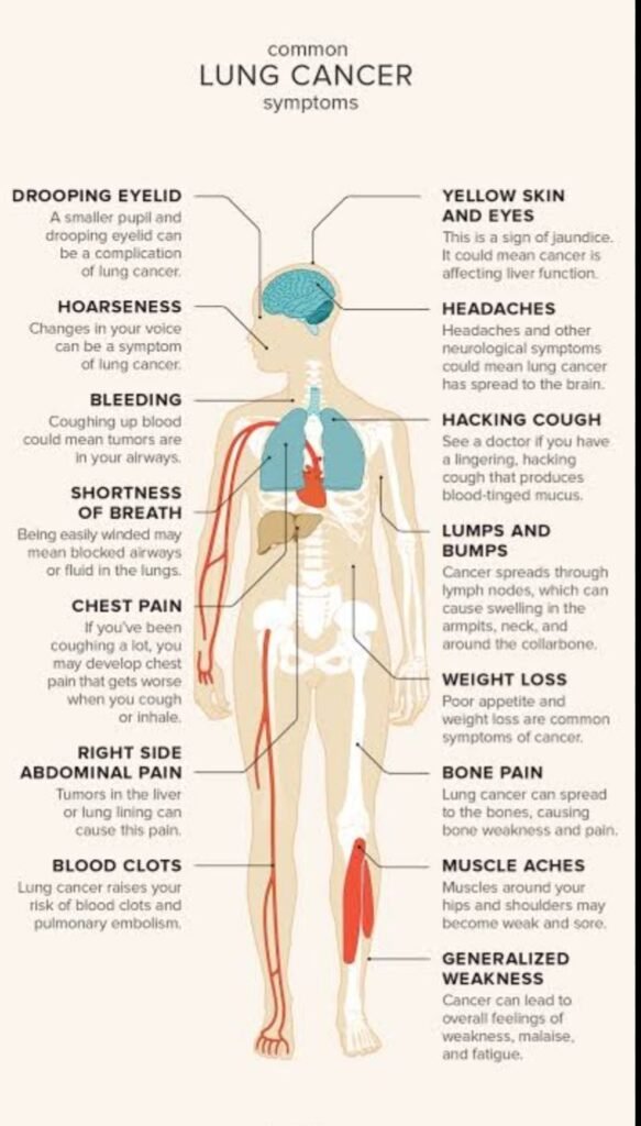 Common Lung Cancer Symptoms You should not ignore. #hilightseveryonefollowers