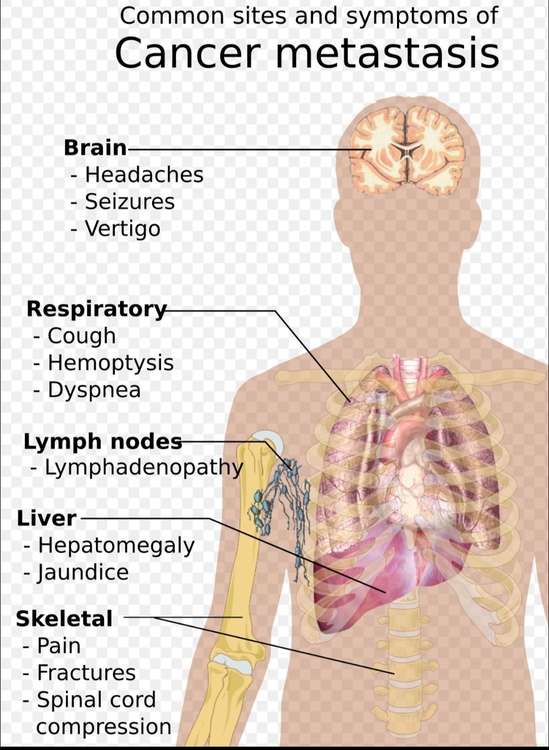 HEALTH TIPS 

Common Sites and Symptoms of Cancer Metastasis 

Metastatic Cancer, where Cancer cells spread fr