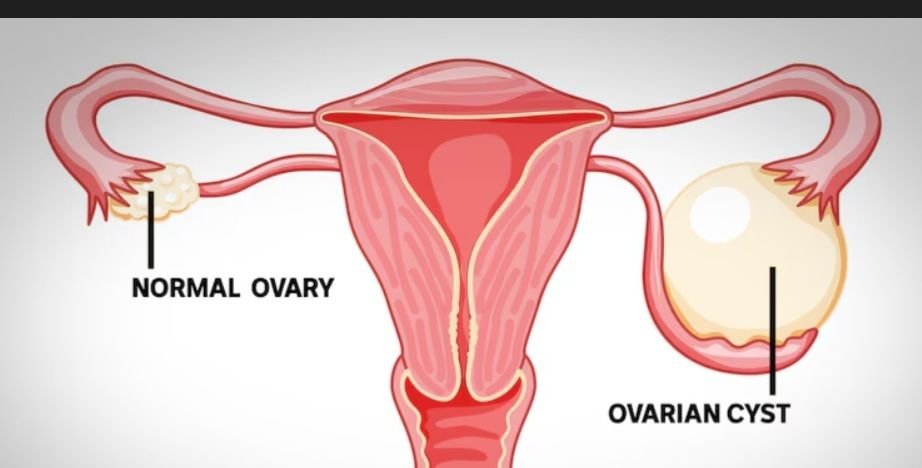 OVARIAN CYST

An ovarian cyst is a fluid filled sac that develops in or an ovary, most commonly in association