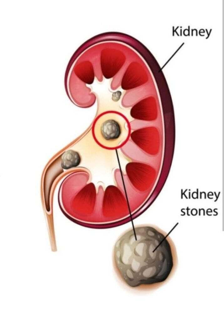 Prevention strategies to avoid recurrence of kidney stones.

1. Balance calcium intake.

2. Reduce sodium and