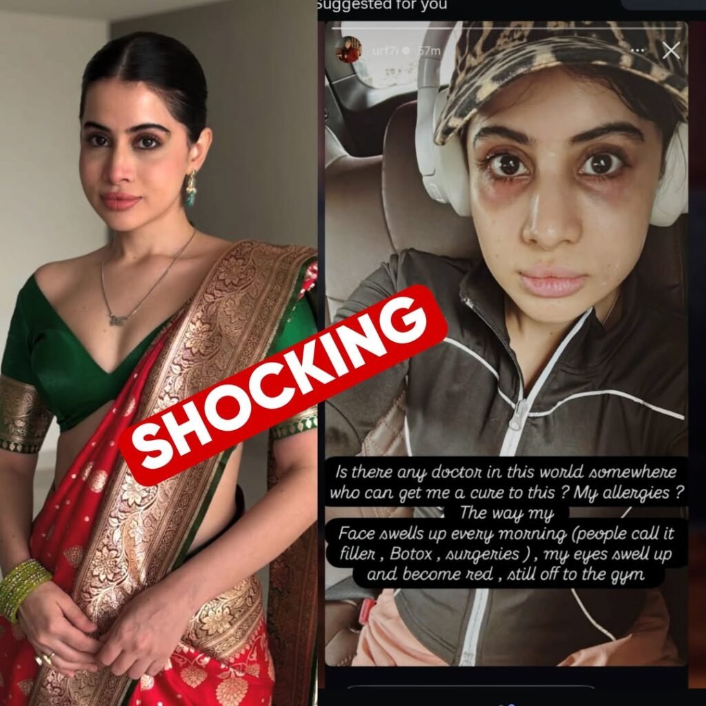 Uorfi Javed’s Face Allergy Scare Leaves Fans Worried! 

In a shocking turn of events, internet sensation and f