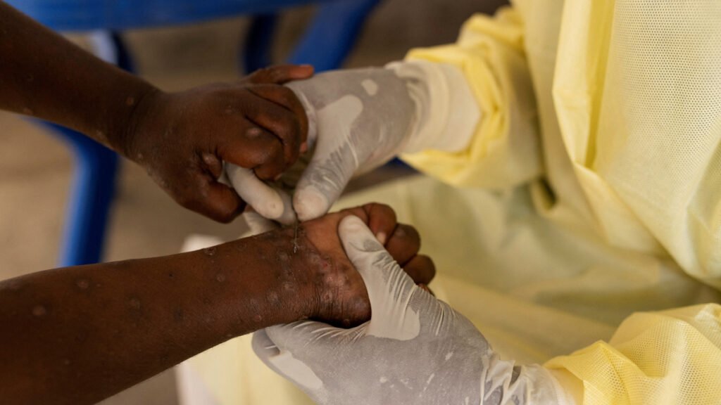 Mpox global outbreak: Will it trigger another pandemic?